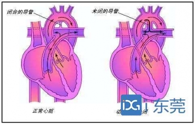 东莞市中病院顺遂完成一例成人先芥蒂参与启堵术-4.jpg