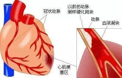 深年夜传授突收心梗猝逝世！记着深圳“心梗舆图”，枢纽时...