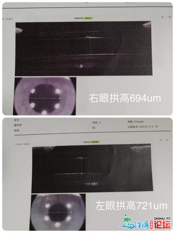 华中大女汉子东莞近视手术日记 摘掉厚厚的酒瓶底值了-2.jpg