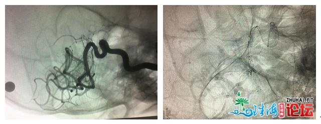 惠州尾例！惠东一动脉瘤患者胜利施行“Y”型收架手艺